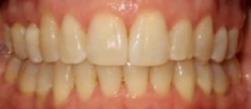 Teath After