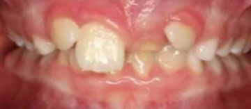 Teath Before