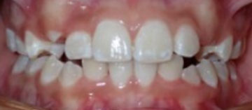 Teath After