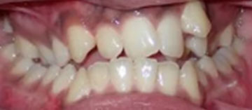 Teath Before