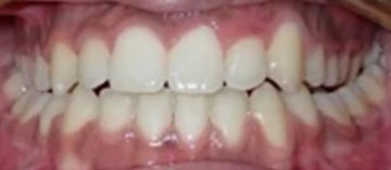 Teath After