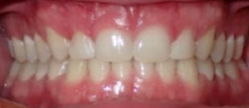 Teath After
