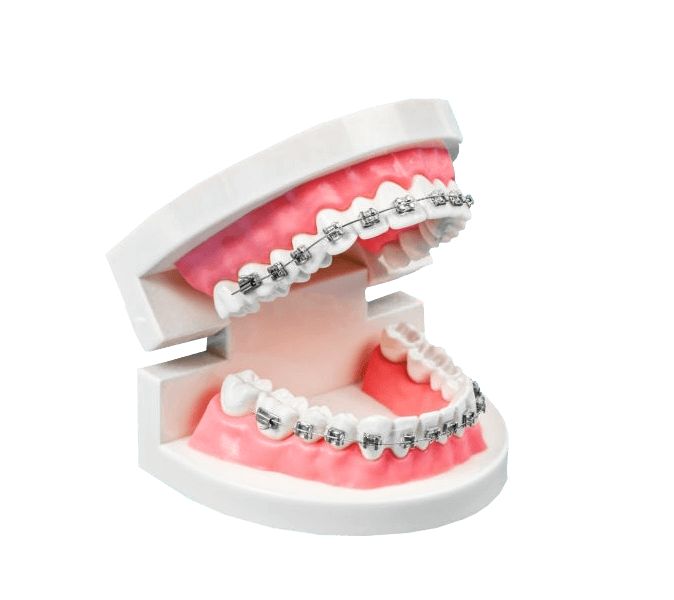 How do braces work?