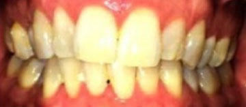 Teath Before