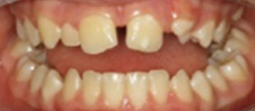 Teath Before