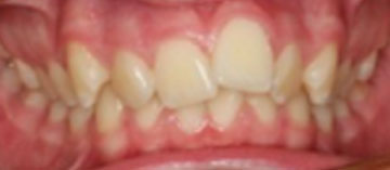 Teath Before