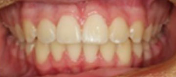 Teath After