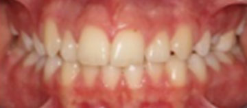 Teath Before