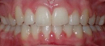 Teath After