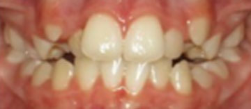 Teath Before