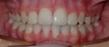 Teath After