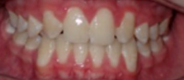 Teath After