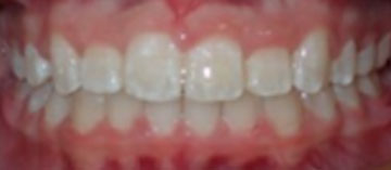Teath After