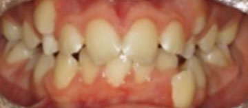 Teath Before
