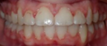 Teath After