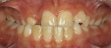 Teath Before