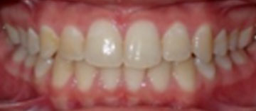 Teath After
