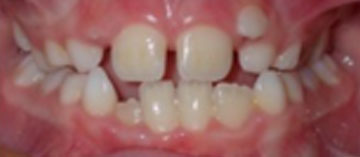 Teath Before