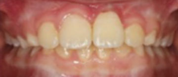 Teath After