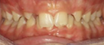 Teath Before