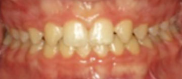 Teath After
