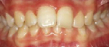 Teath Before