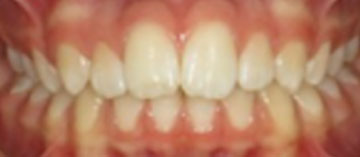 Teath Before