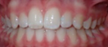 Teath After