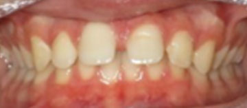 Teath Before