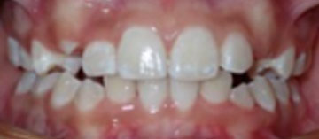Teath After