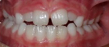 Teath Before