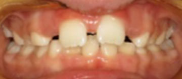 Teath Before