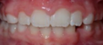 Teath After