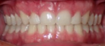 Teath After