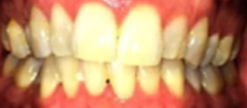 Teath Before