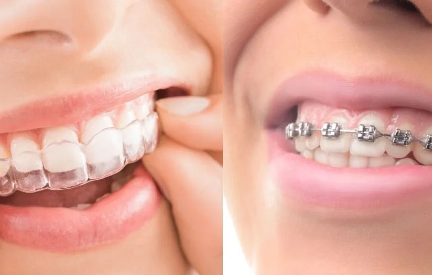 What Do Braces Really Cost In Sydney? Breaking Down The Numbers For Families