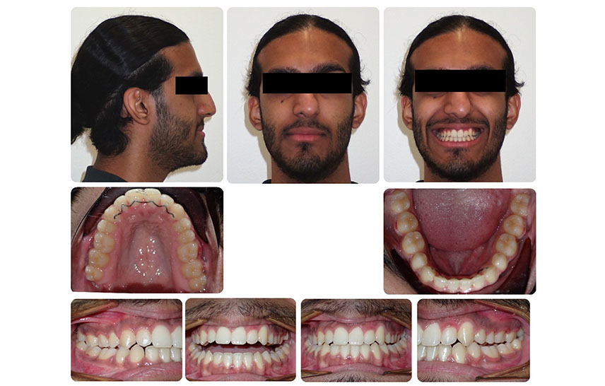 From Crowding to Confidence: An Adult Braces Transformation