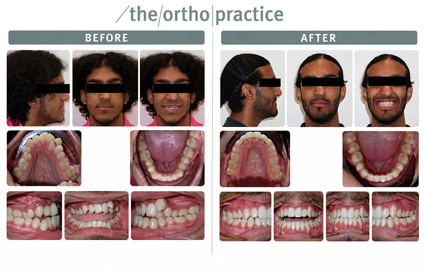 From Crowding to Confidence: An Adult Braces Transformation